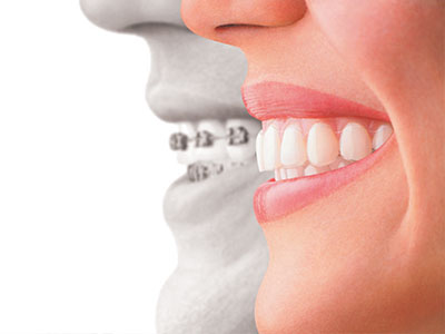 The image shows a split-screen comparison between a smiling person s face and an x-ray of a mouth with braces, highlighting the transformation from a natural smile to one with orthodontic treatment.