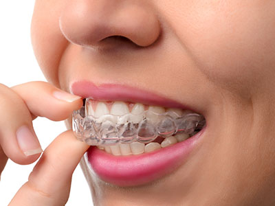 A person s hand holding a transparent aligner with teeth-like structures against their mouth.