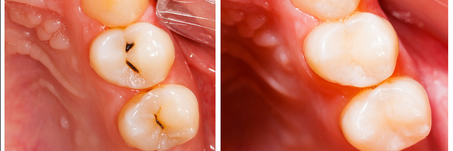 The image shows a close-up view of a dental implant with two visible screws, set against a background that appears to be an open mouth with teeth and gums.